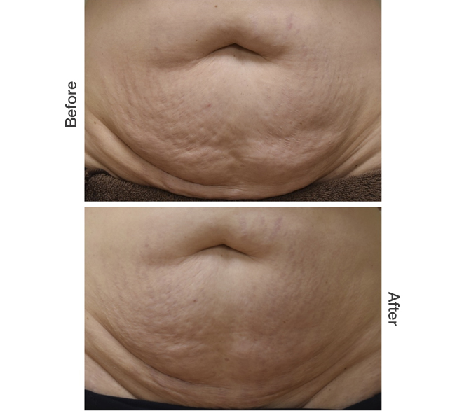 Microneedling Belly Stomach