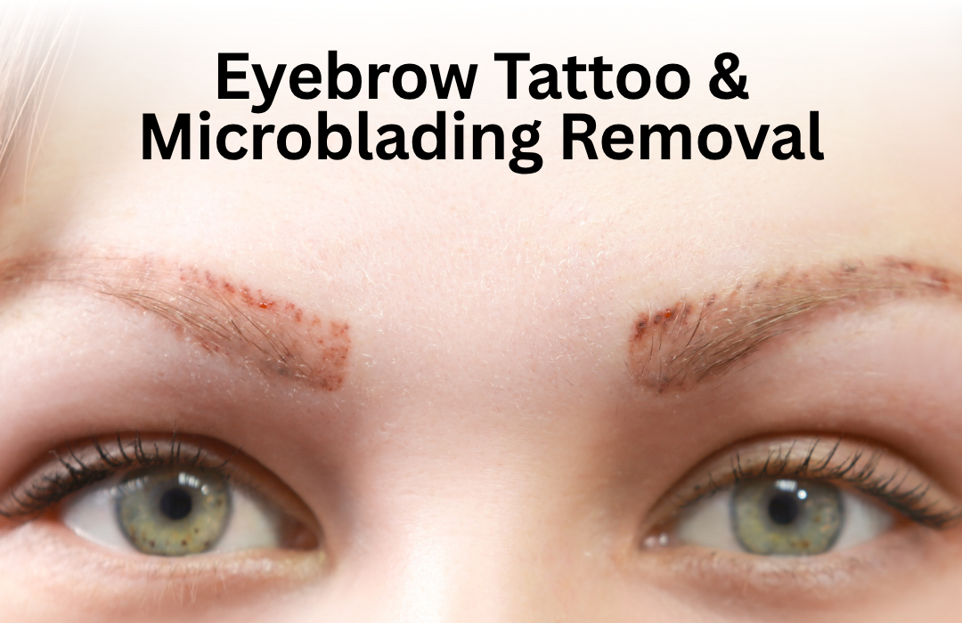 Odettes - Eyebrow tattoo removal eyebrow tattoo and microblading removal